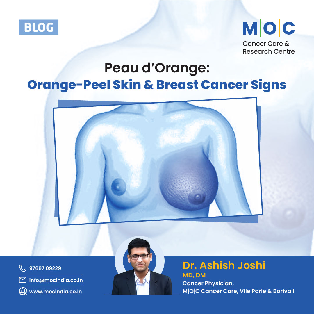 Peau d’Orange: Orange-Peel Skin and Breast Cancer Signs